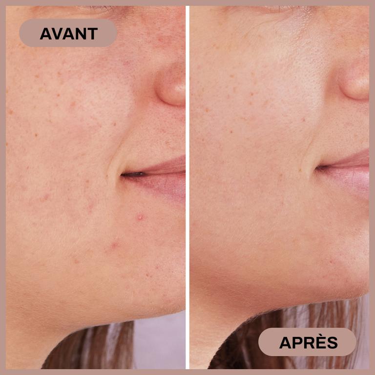 Sérum 2-en-1 SOS Imperfections à l'Acide Salicylique